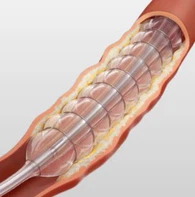 Nitinol PTA Balloon Catheter